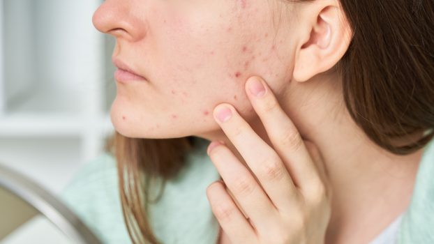 Widoczny na zdjęciu trądzik i krosty powodują m.in. zmiany hormonalne, podłoże genetyczne, zanieczyszczone środowisko, obniżona odporność